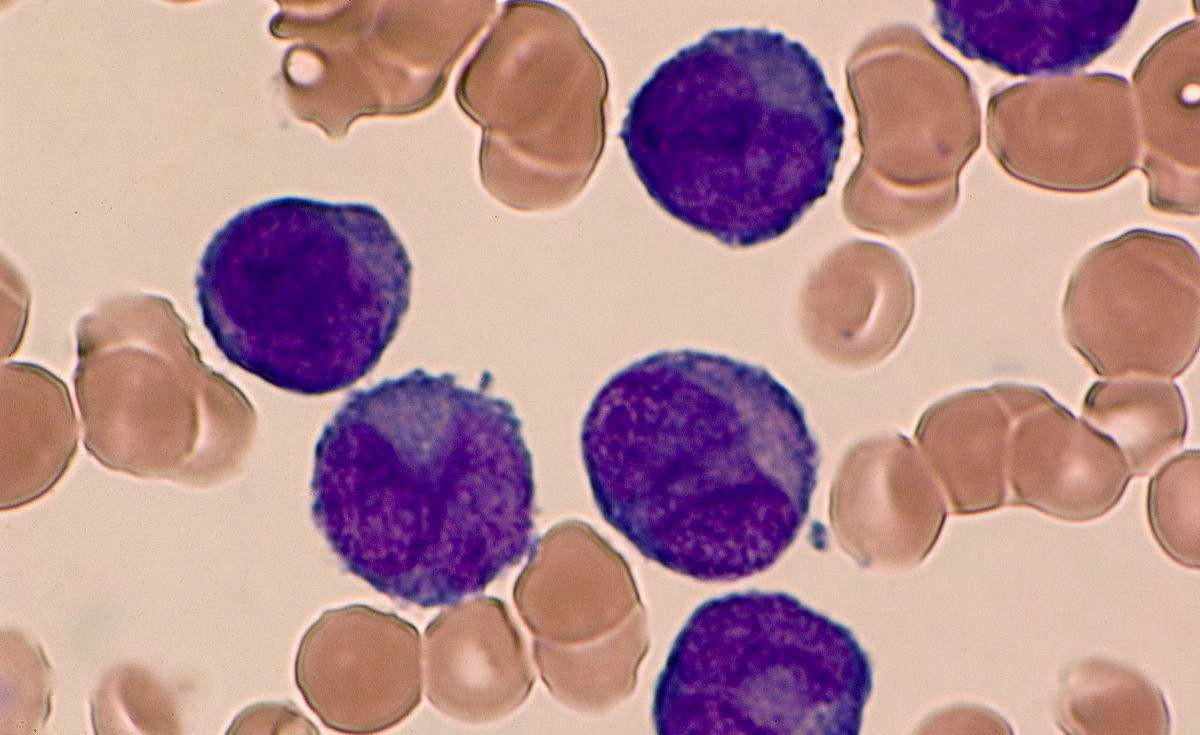 家庭裝修是導(dǎo)致白血病的***因素！家里甲醛超標(biāo)怎么辦