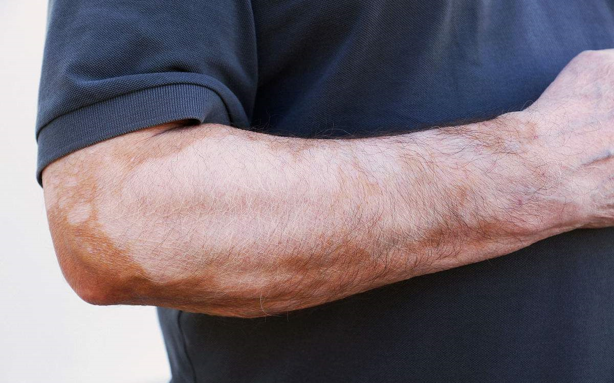 甲醛超標(biāo)和白癜風(fēng)有關(guān)系嗎？裝修污染對人體影響極大！